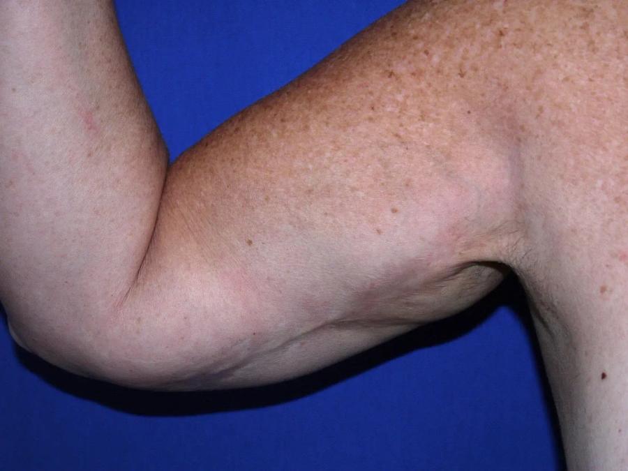 Arm Lift before
