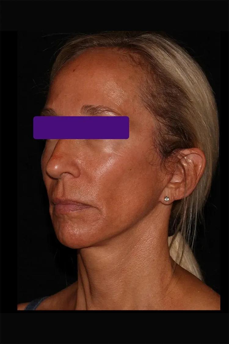 Facelift (neck lift included) after