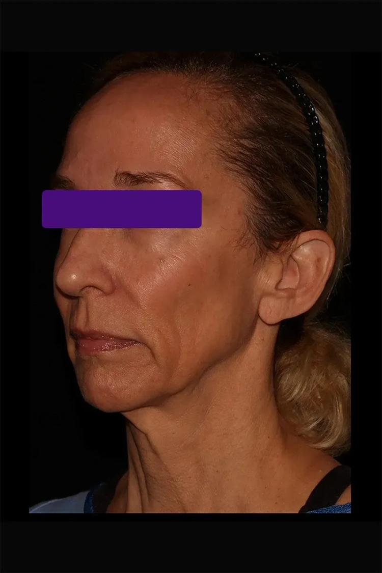Facelift (neck lift included) before