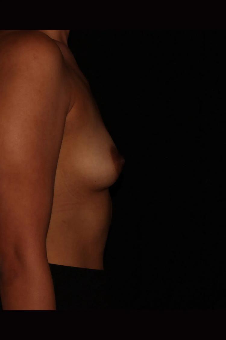 Breast Augmentation with Implants, view 3, before