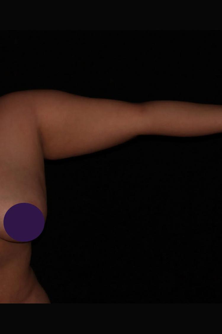 Arm Lift before