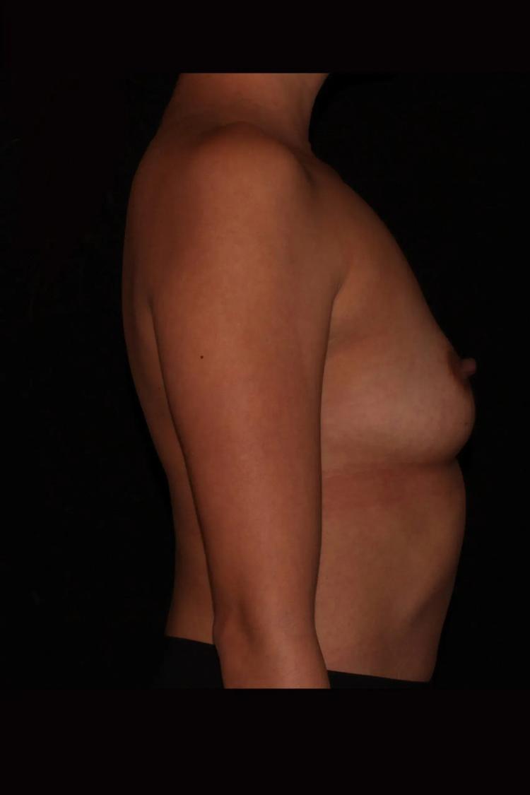 Breast Augmentation with Implants, view 3, before