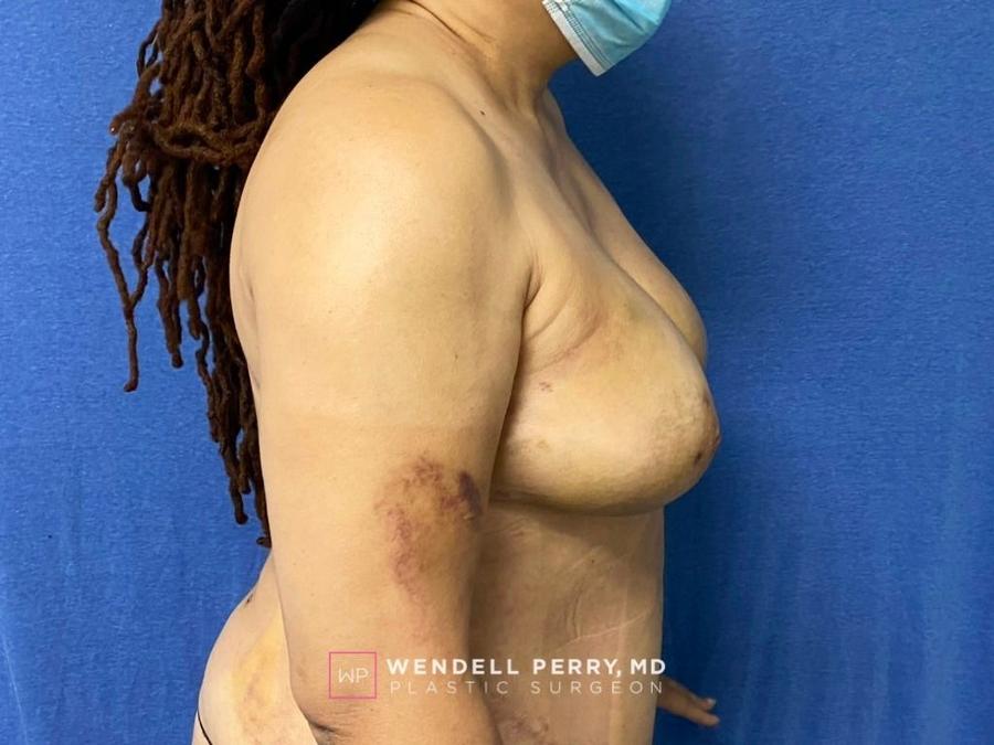 Fat Transfer To the Breast, view 3, after