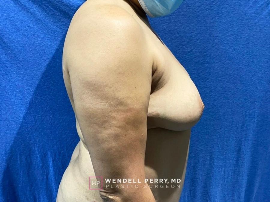 Fat Transfer To the Breast, view 3, before