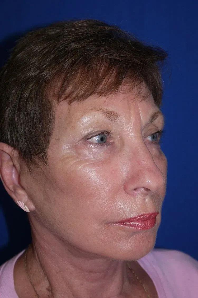 Necklift after