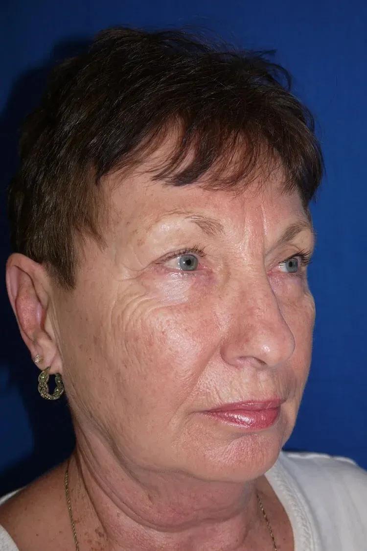 Necklift before