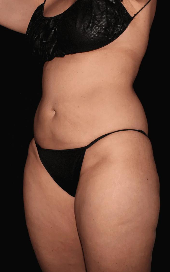 Vaser Lipo 360 (5L Max) before