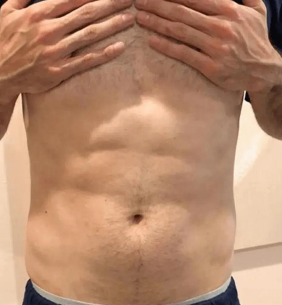 Emsculpt Neo after
