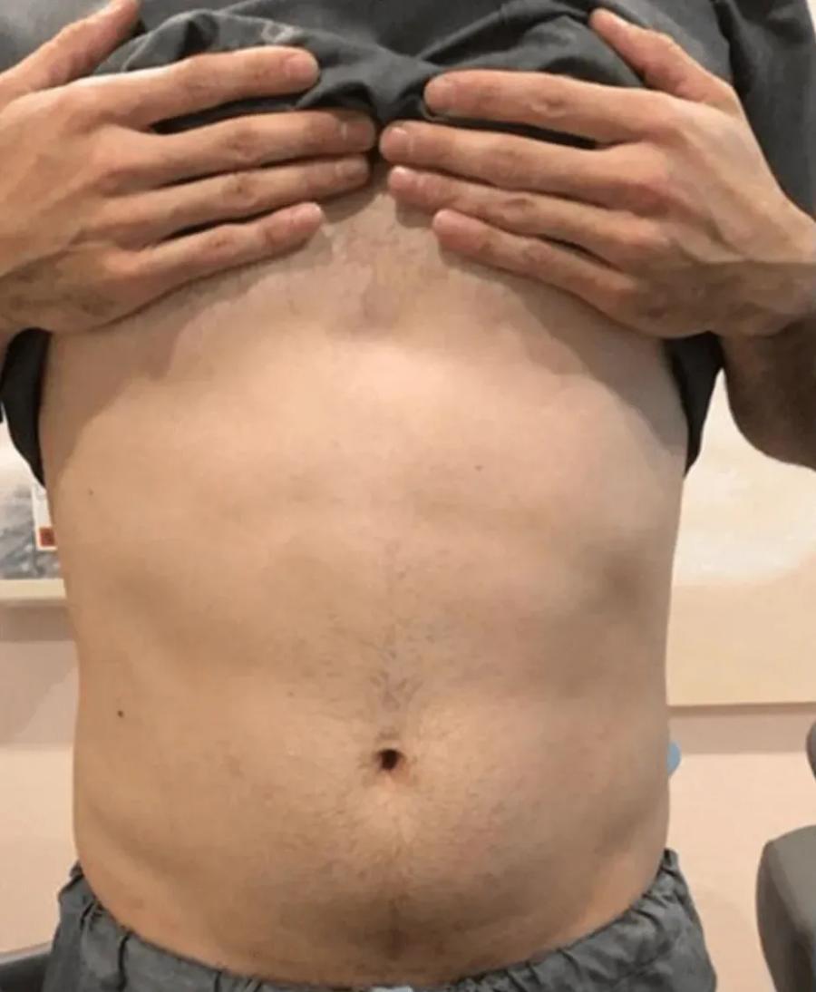 Emsculpt Neo before