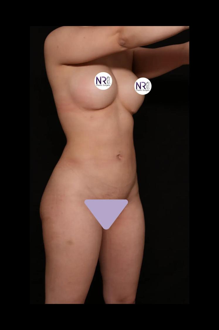 Front Liposuction (5L) (Same As Lipo360) after