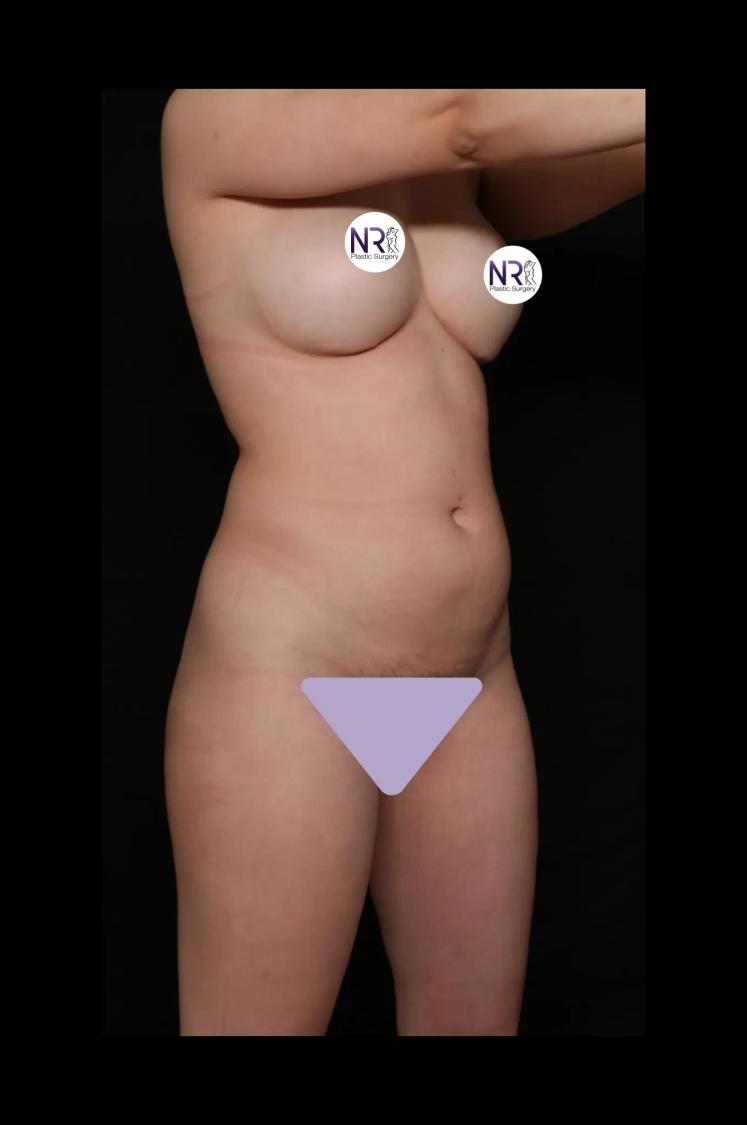 Front Liposuction (5L) (Same As Lipo360) before