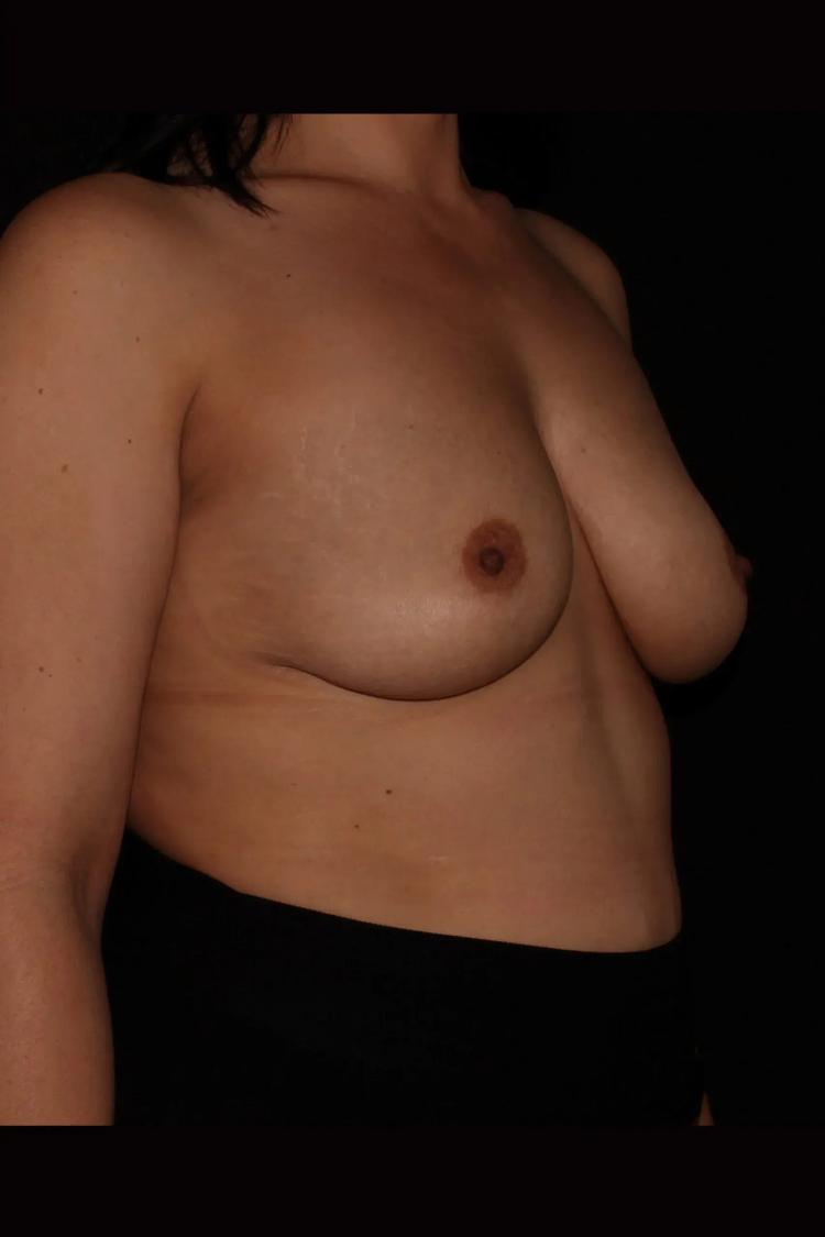 Breast Augmentation with Implants before