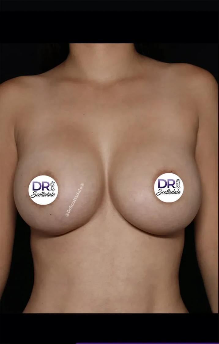 Breast Augmentation with Implants after