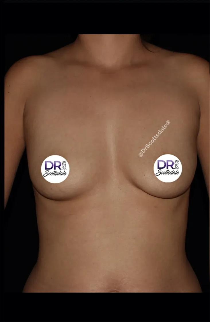 Breast Augmentation with Implants before