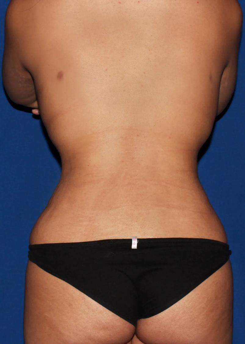 Front Liposuction (5L) (Same As Lipo360), view 4, after