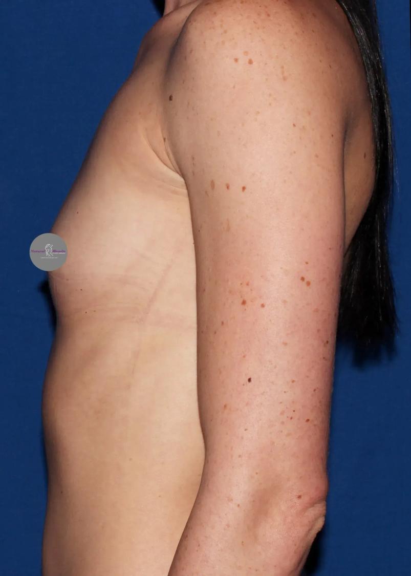Breast Augmentation with Implants, view 3, before