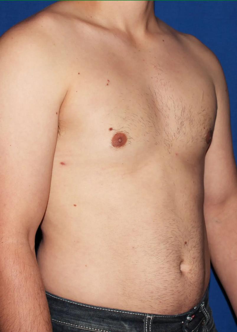 One-Stitch Gynecomastia, view 2, after