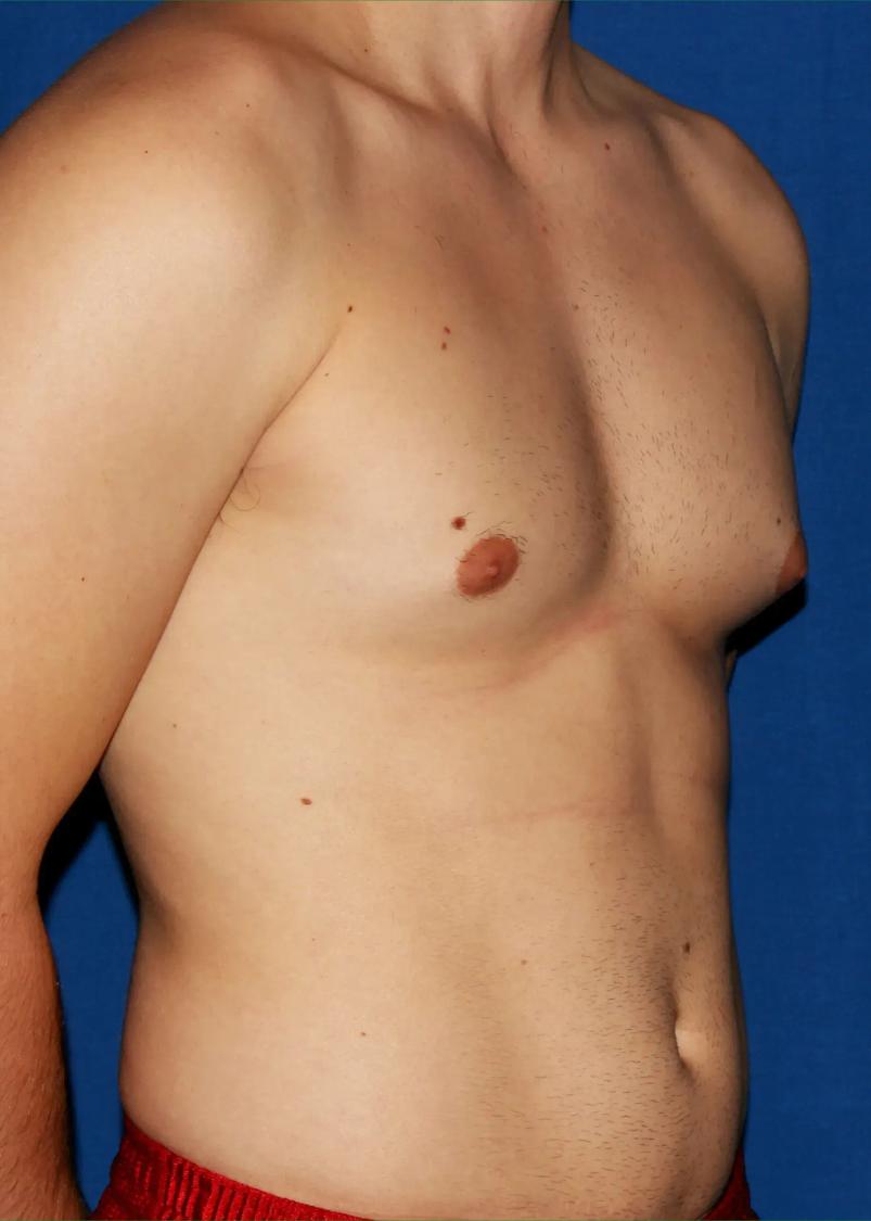 One-Stitch Gynecomastia, view 2, before