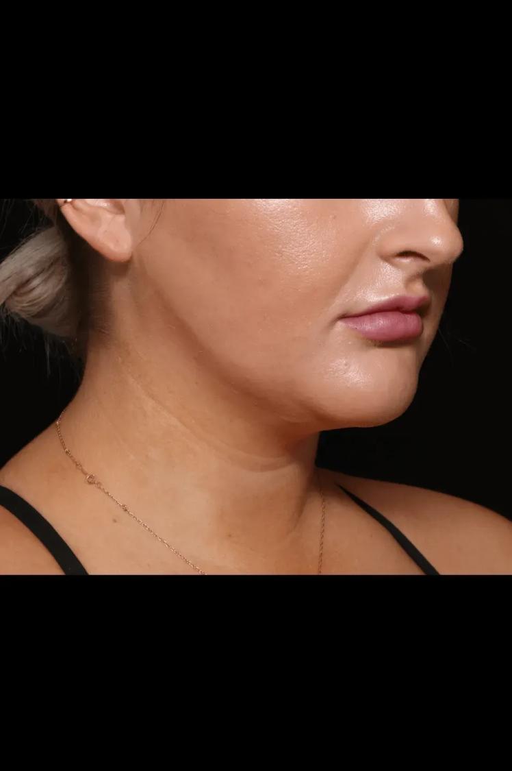 Buccal Fat Pad Removal after