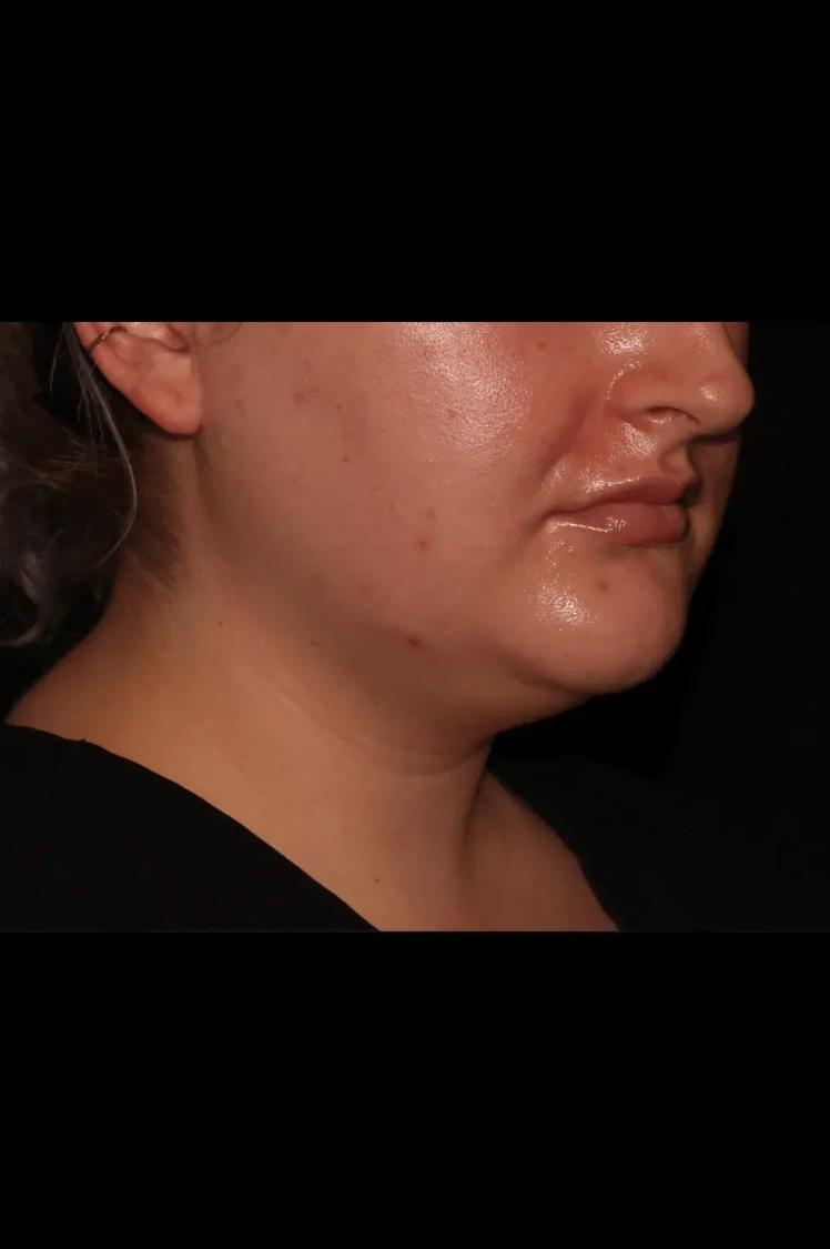 Buccal Fat Pad Removal before