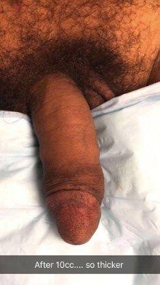 Penis Filler after