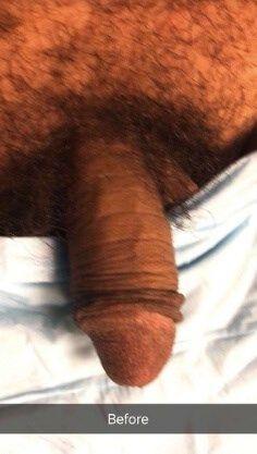 Penis Filler before