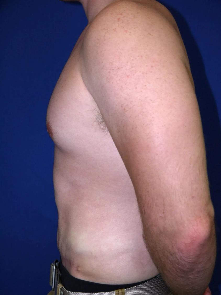 Tummy Tuck, view 4, after
