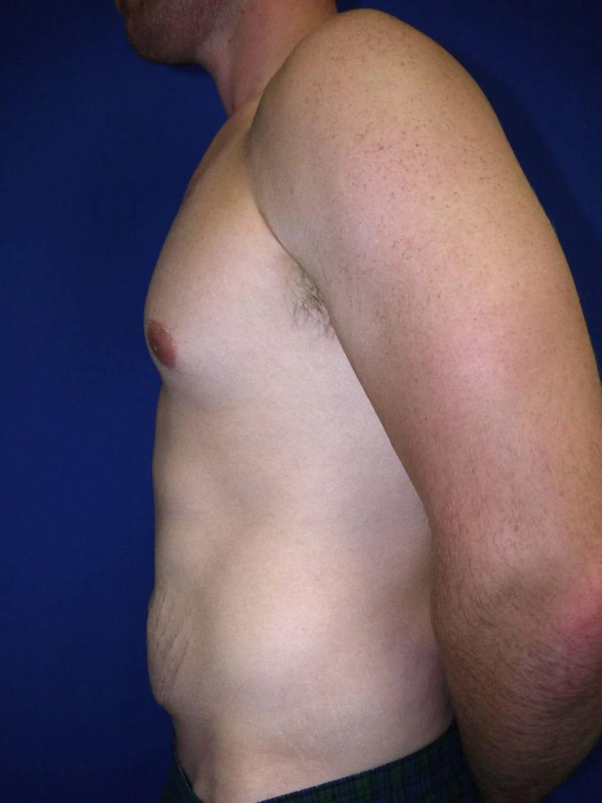 Tummy Tuck, view 4, before