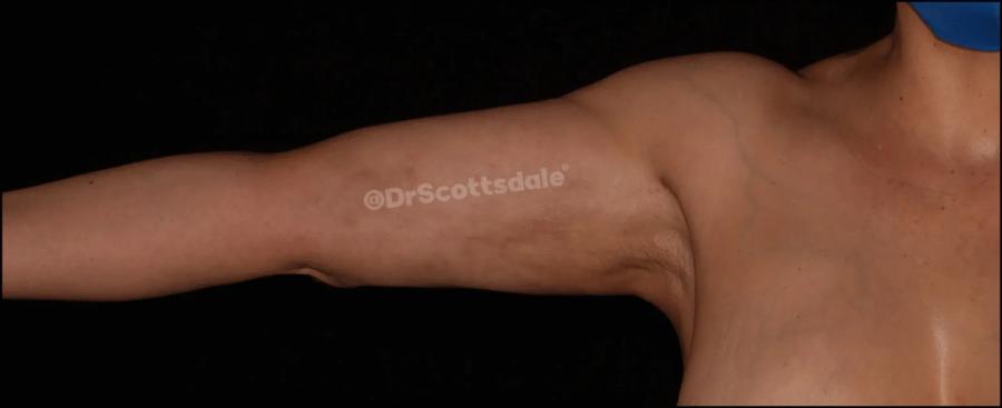 Arm Lift after