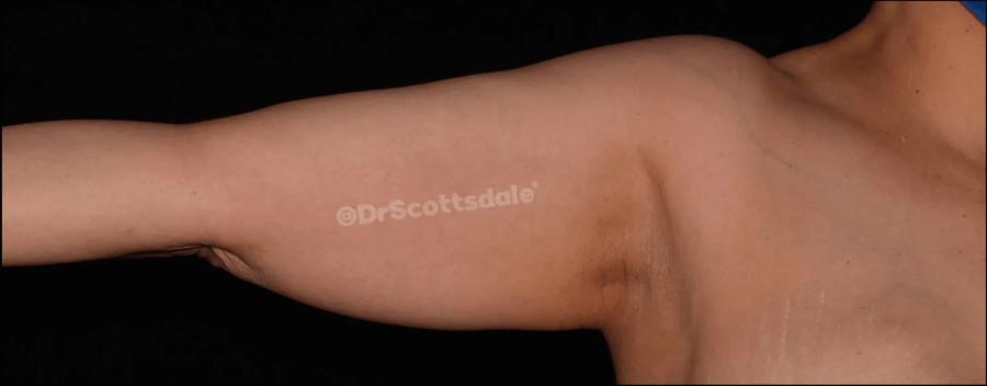 Arm Lift before