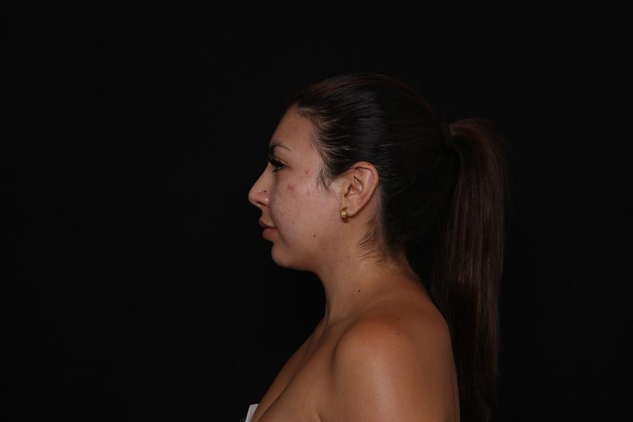 Neck Liposuction w/ Magic Tight, view 5, after