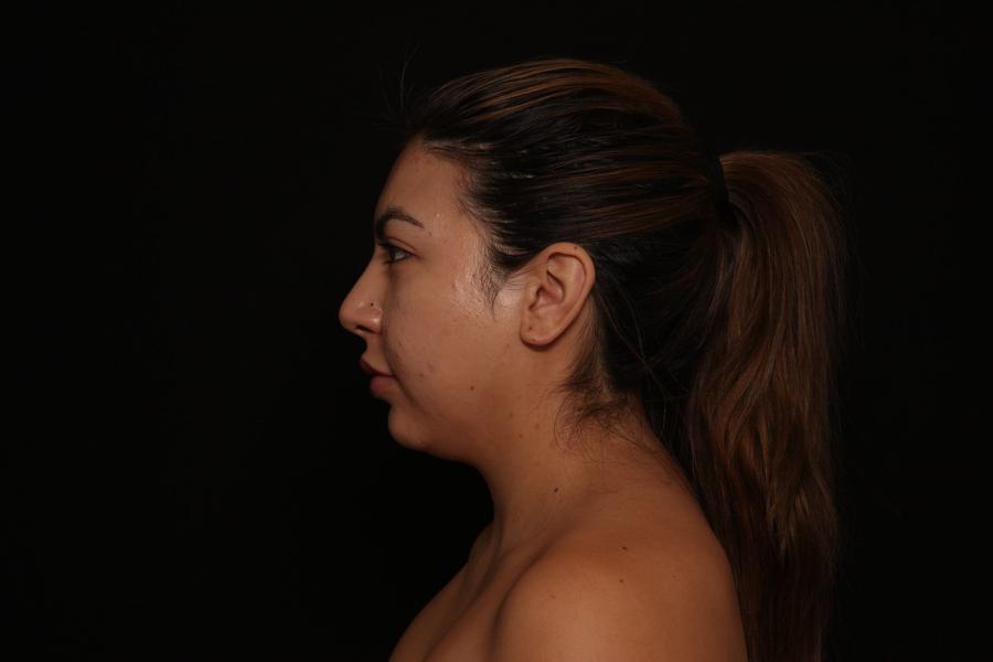 Neck Liposuction w/ Magic Tight, view 5, before