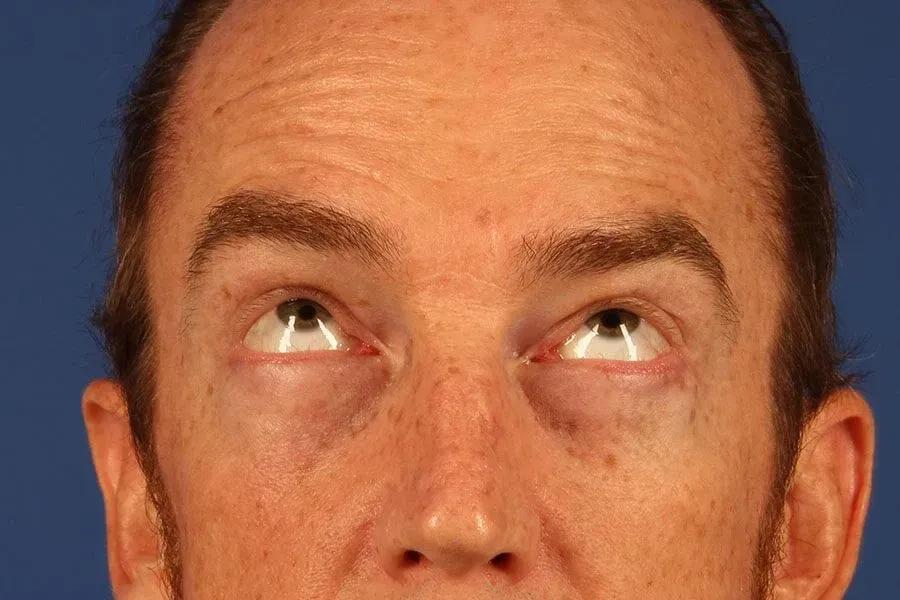 Eyelid Surgery after