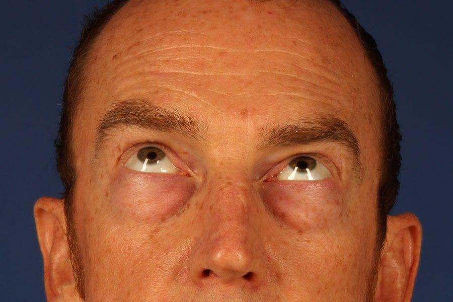 Eyelid Surgery before