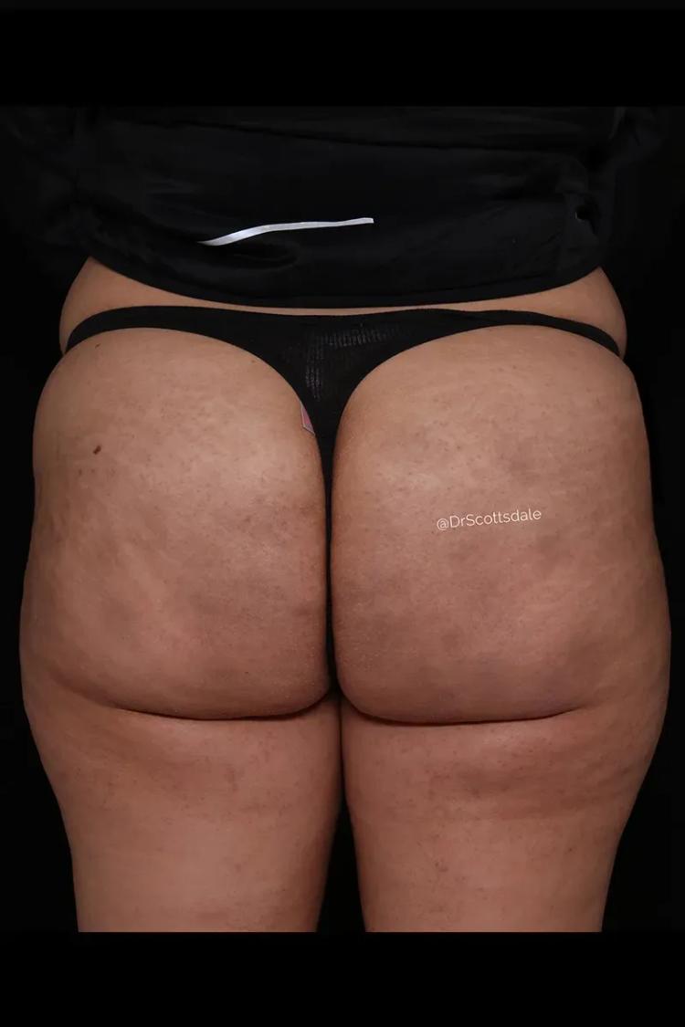 Lipedema after