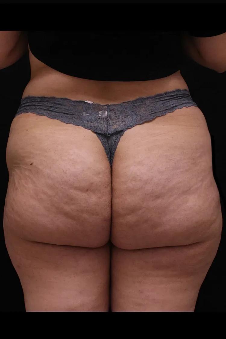 Lipedema before