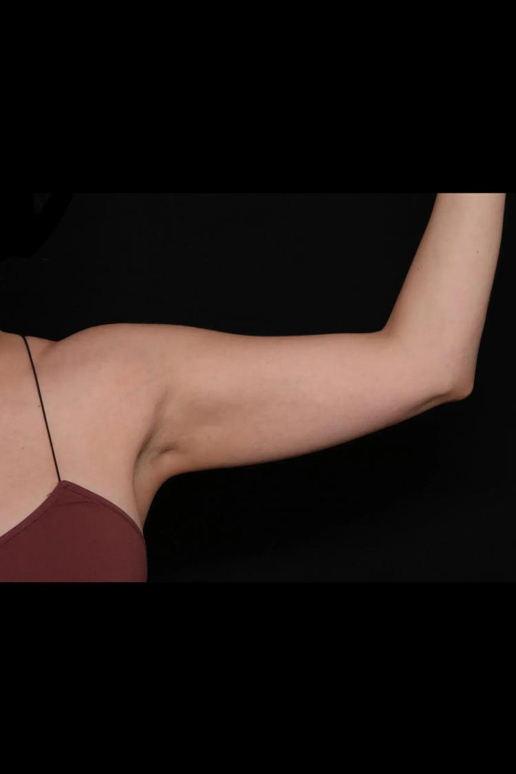 Arm Lift before