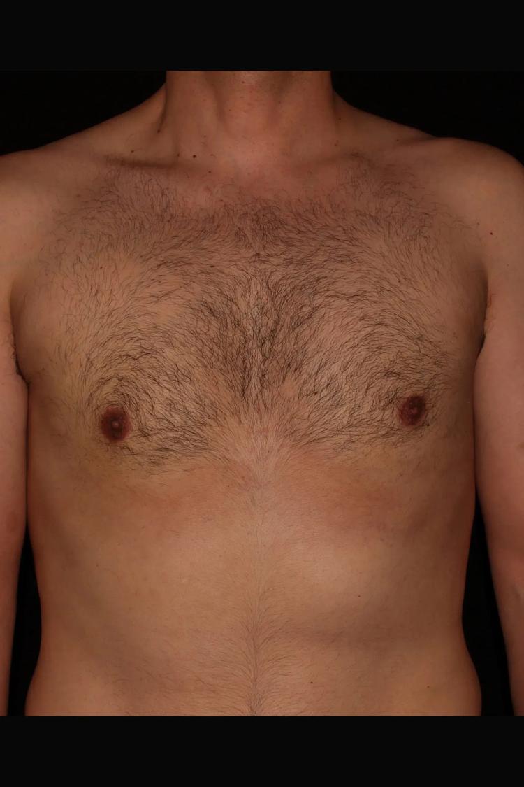 One-Stitch Gynecomastia after
