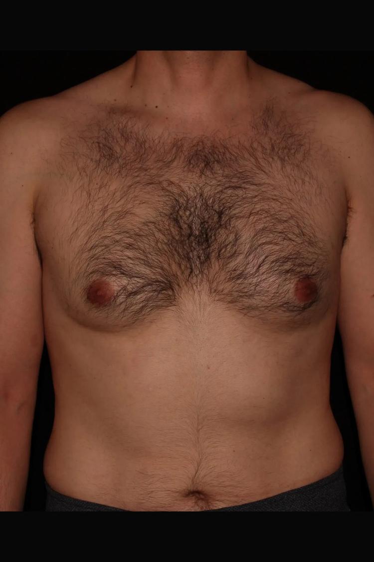 One-Stitch Gynecomastia before
