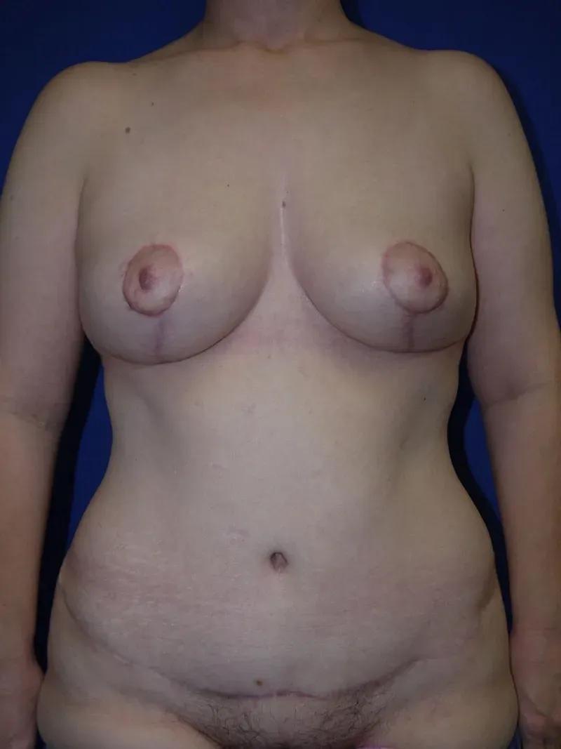 Breast Reduction after