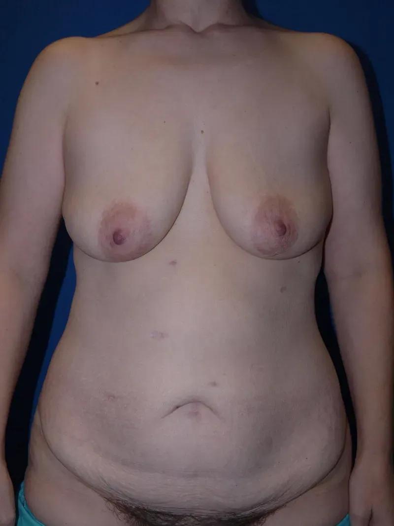 Breast Reduction before