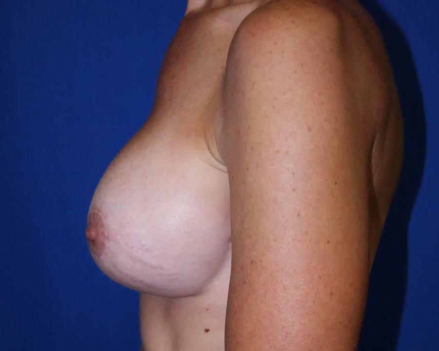 Breast Augmentation with Implants, view 2, after