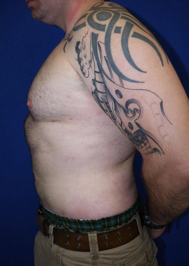 Tummy Tuck, view 3, after