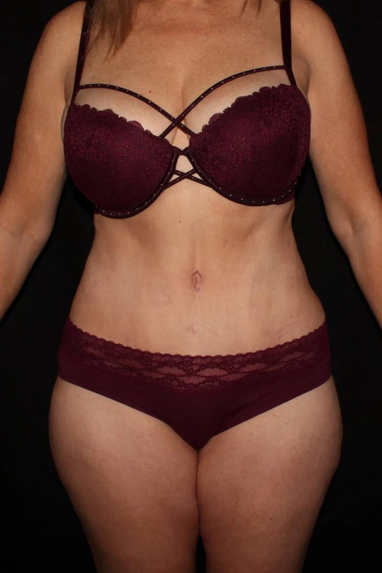 Tummy Tuck after
