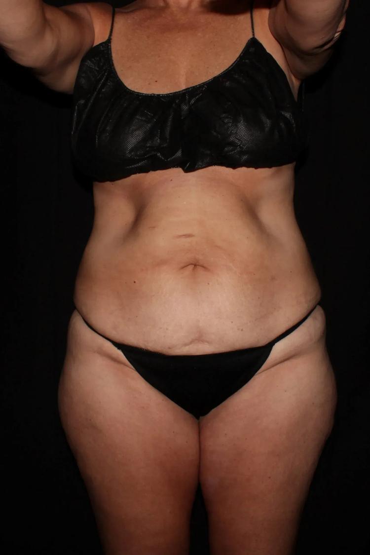 Tummy Tuck before
