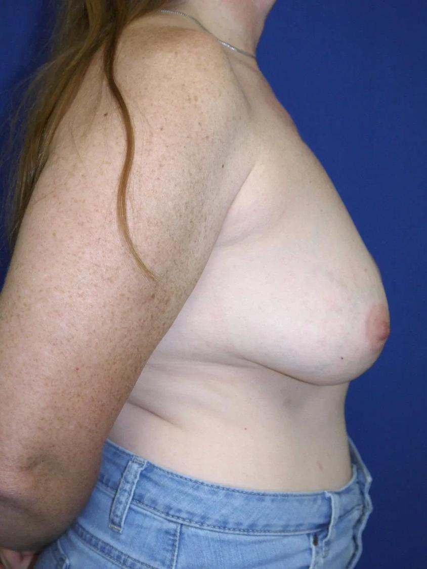 Breast Augmentation with Implants, view 2, before