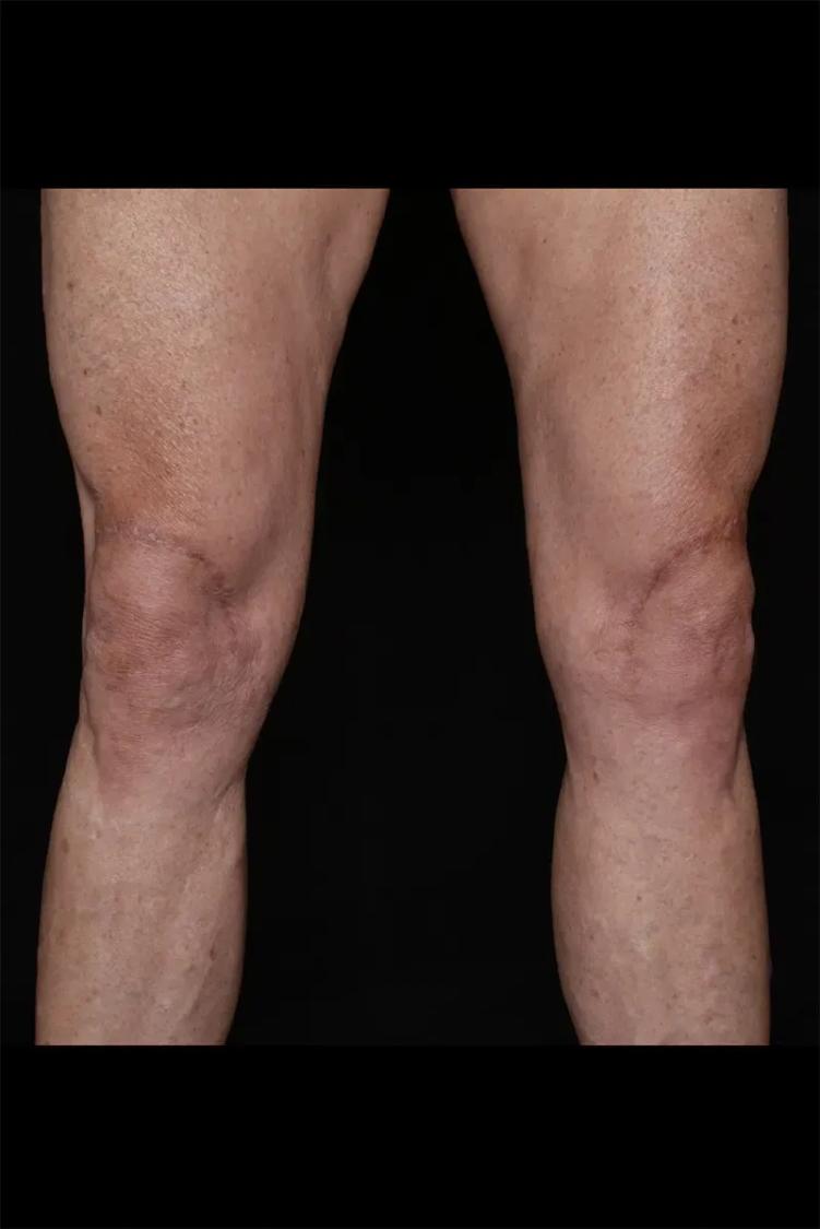 Thigh Lift (Medial) after