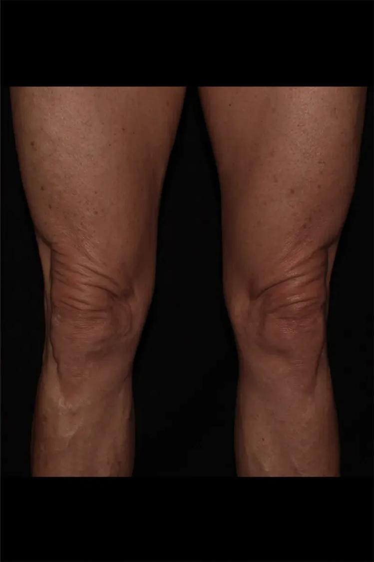 Thigh Lift (Medial) before