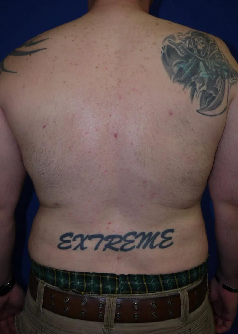 Tummy Tuck, view 5, after