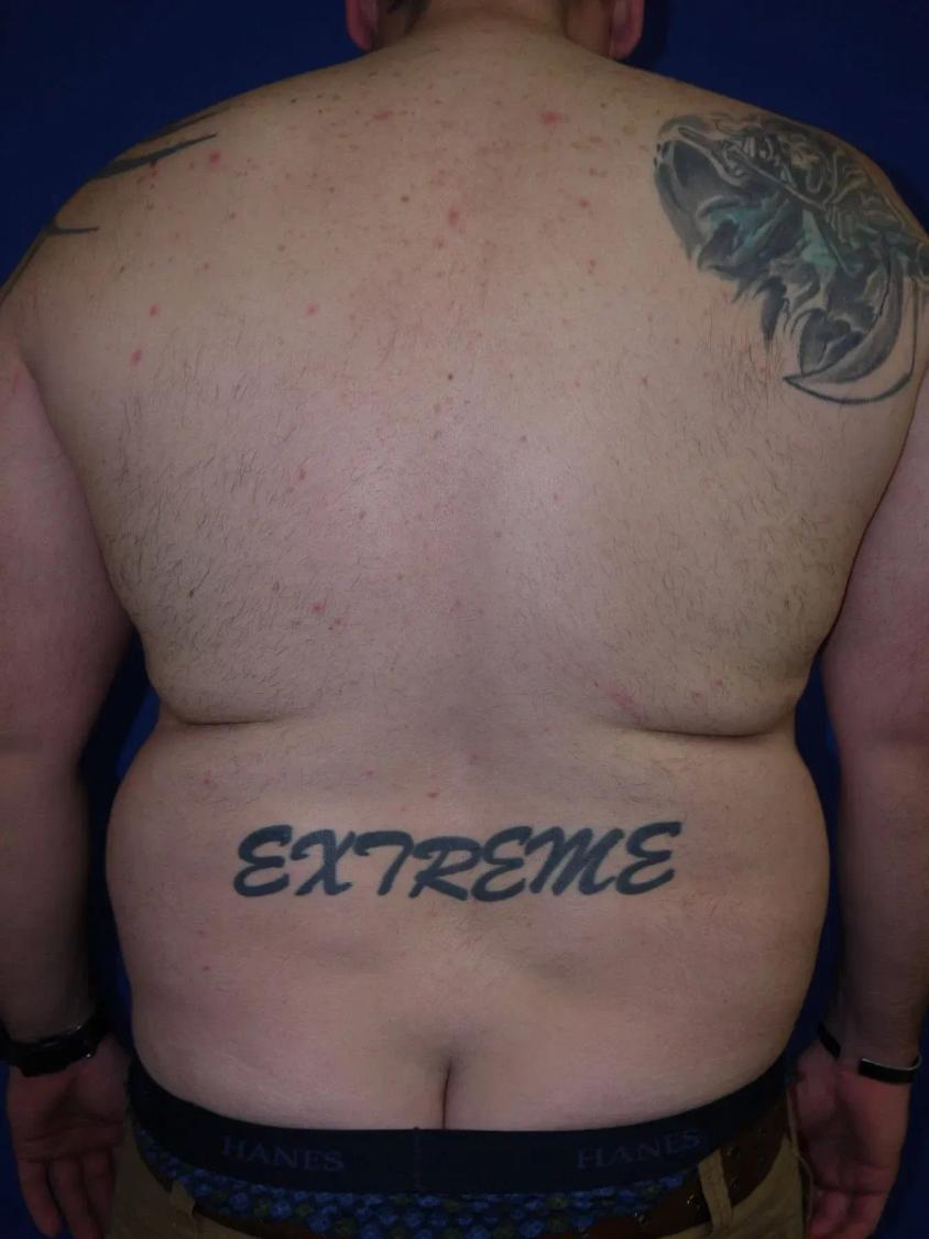 Tummy Tuck, view 5, before